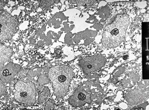 M,61y. | carcinoma - submandibular gland M,61y. | carcinoma - submandibular gland